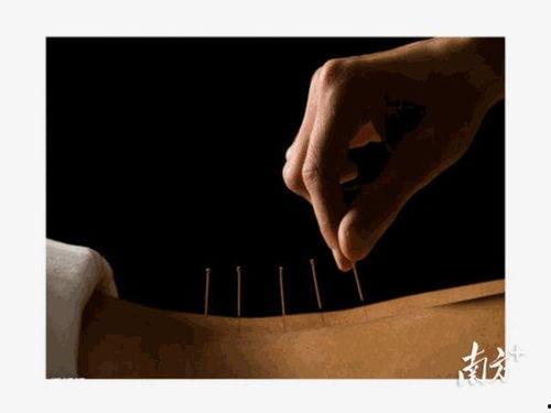 外国网红尝试针灸,揭秘东方神秘疗法的神奇魅力